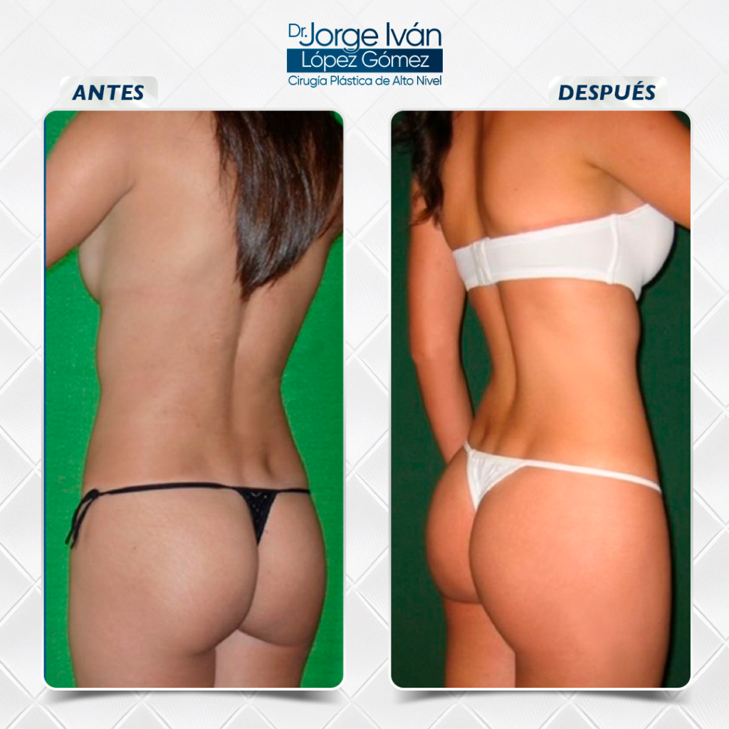 Lipo+gluteoplastia