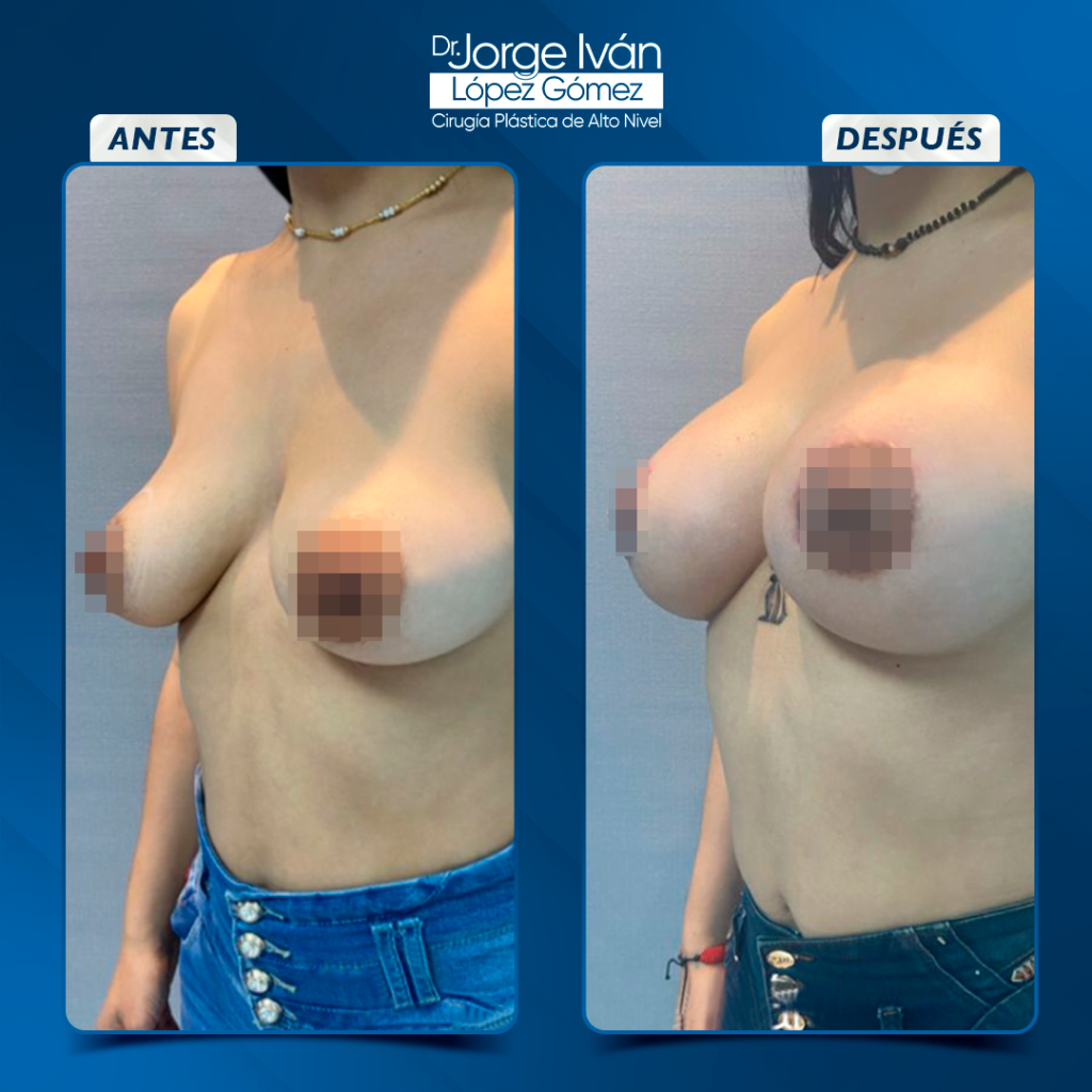 Mamoplastia de aumento 7