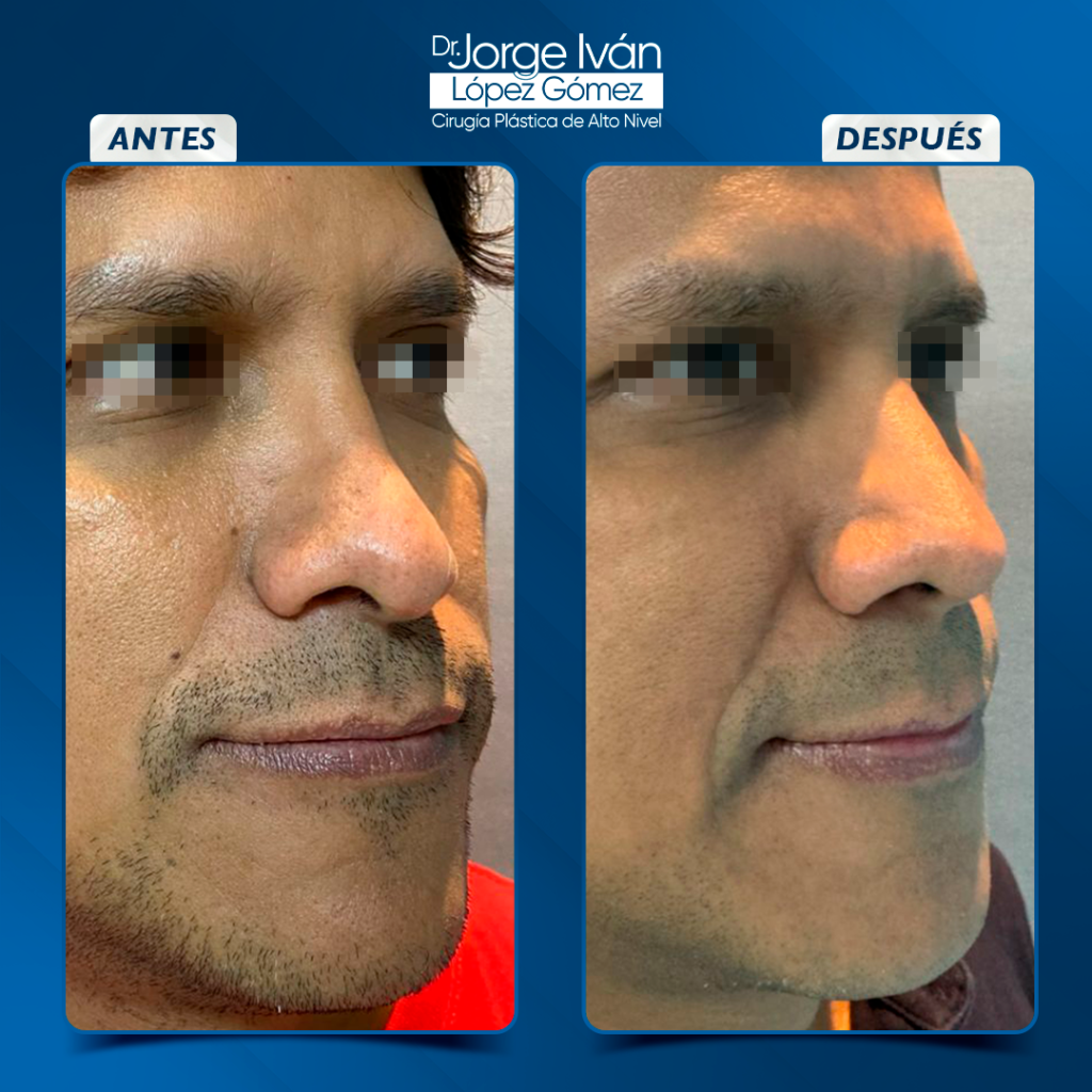 RInoplastia3