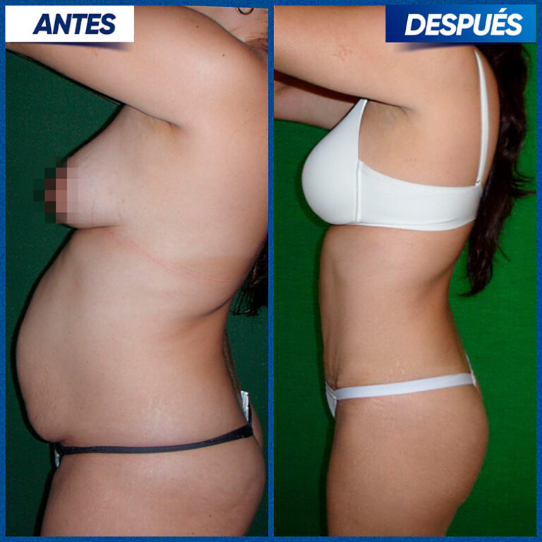 Abdomino-Jorge-Ivan1