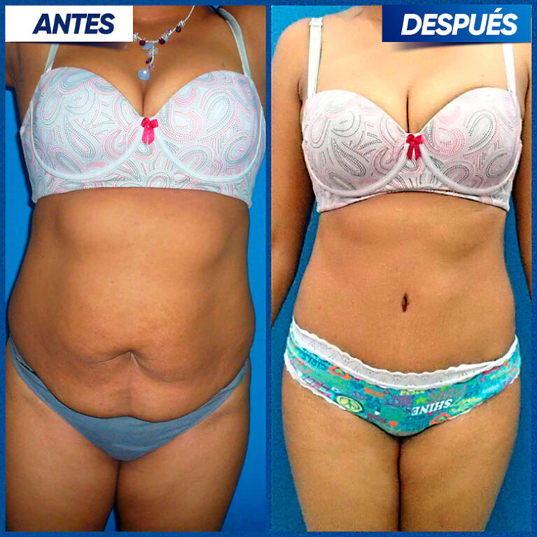 Abdomino-Jorge-Ivan2