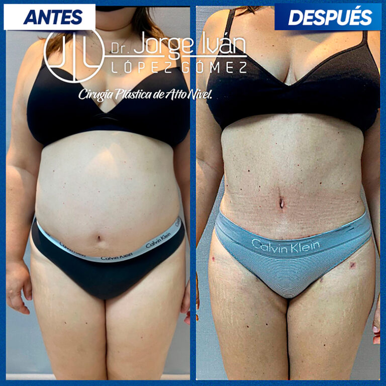 Abdomino-Jorge-Ivan3