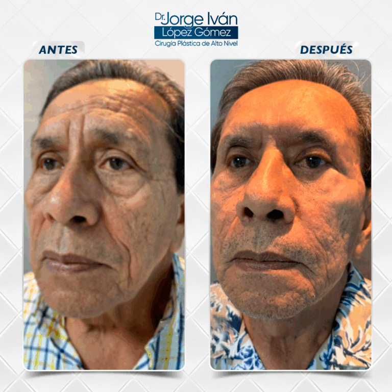 Rejuvencimiento facial5