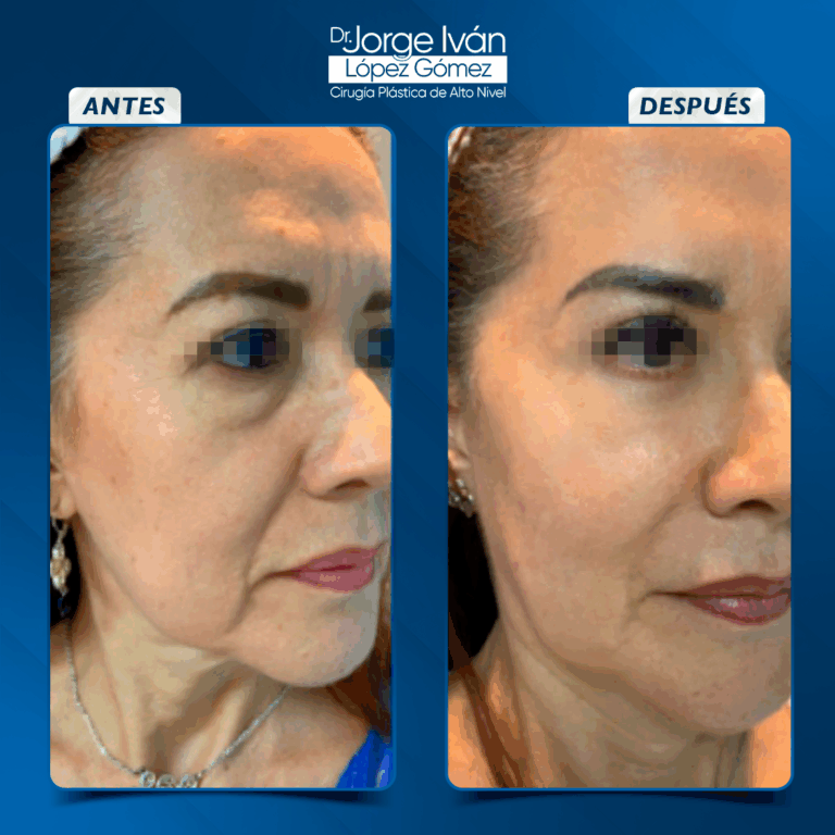 Rejuvenecimiento Facial