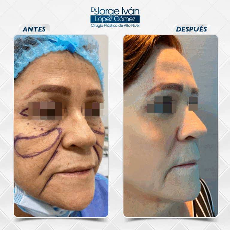Rejuvenecimiento Facial10