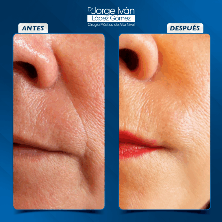 Rejuvenecimiento Facial11