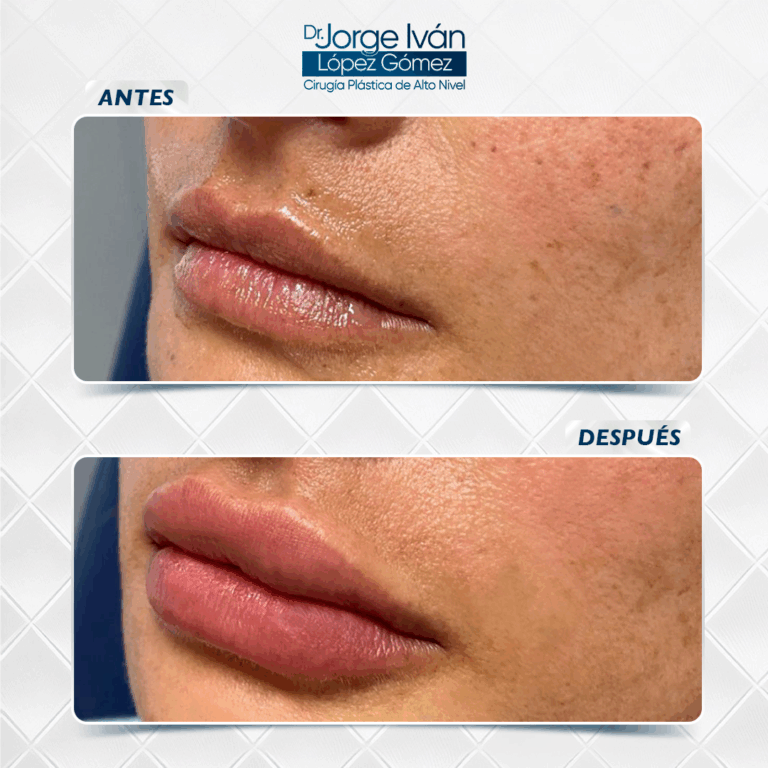 Rejuvenecimiento Facial2