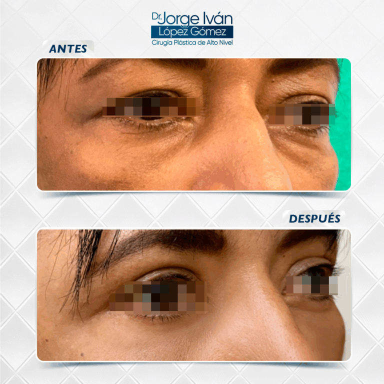 Rejuvenecimiento Facial4