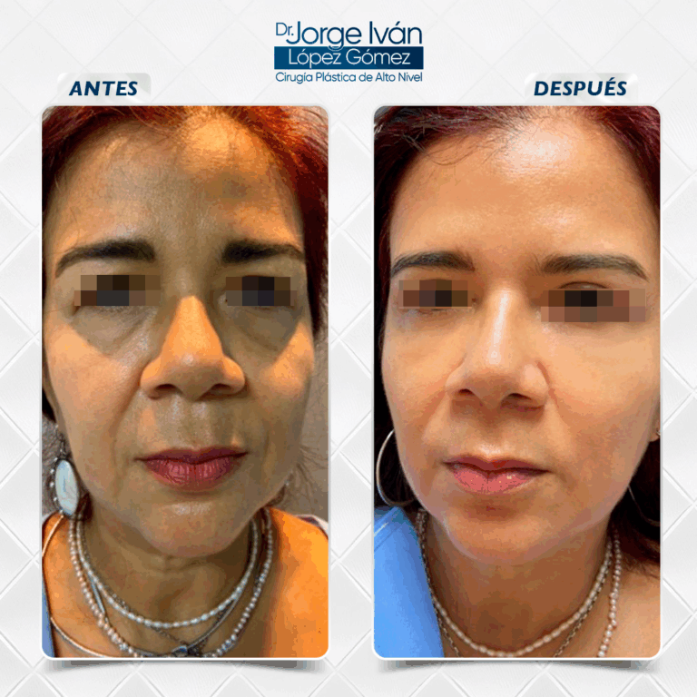 Rejuvenecimiento Facial5