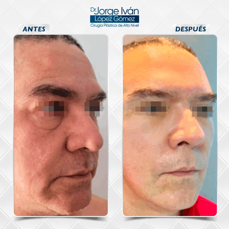 Rejuvenecimiento Facial9