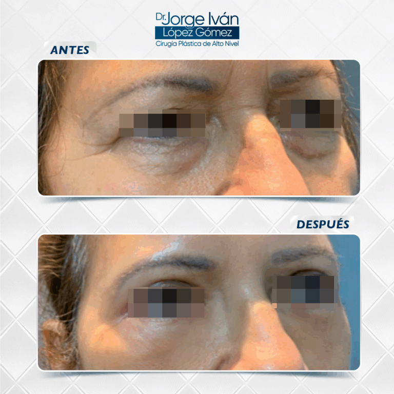 Rejuvenecimiento facial8