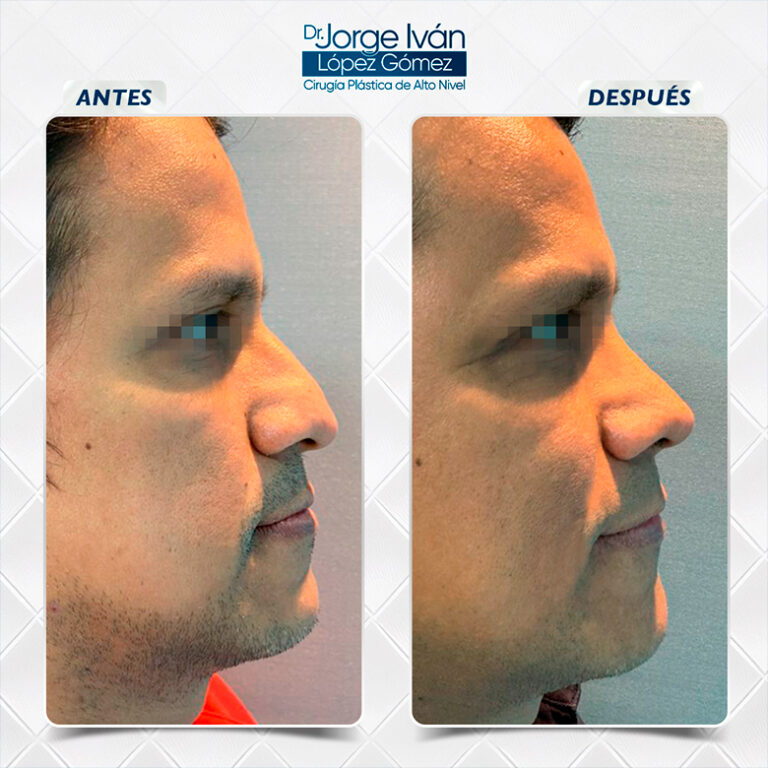 Rinoplastia-Jorgeivan1