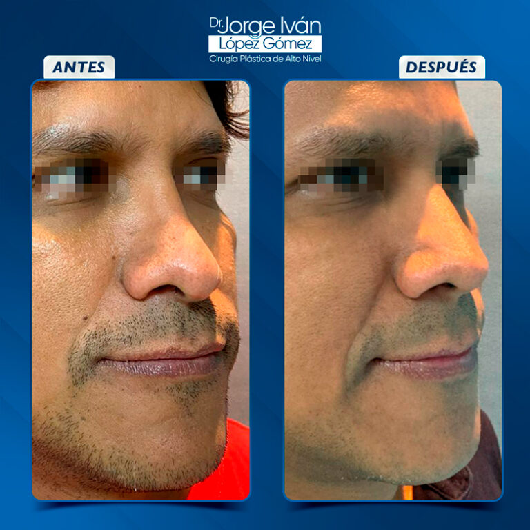 Rinoplastia-Jorgeivan2