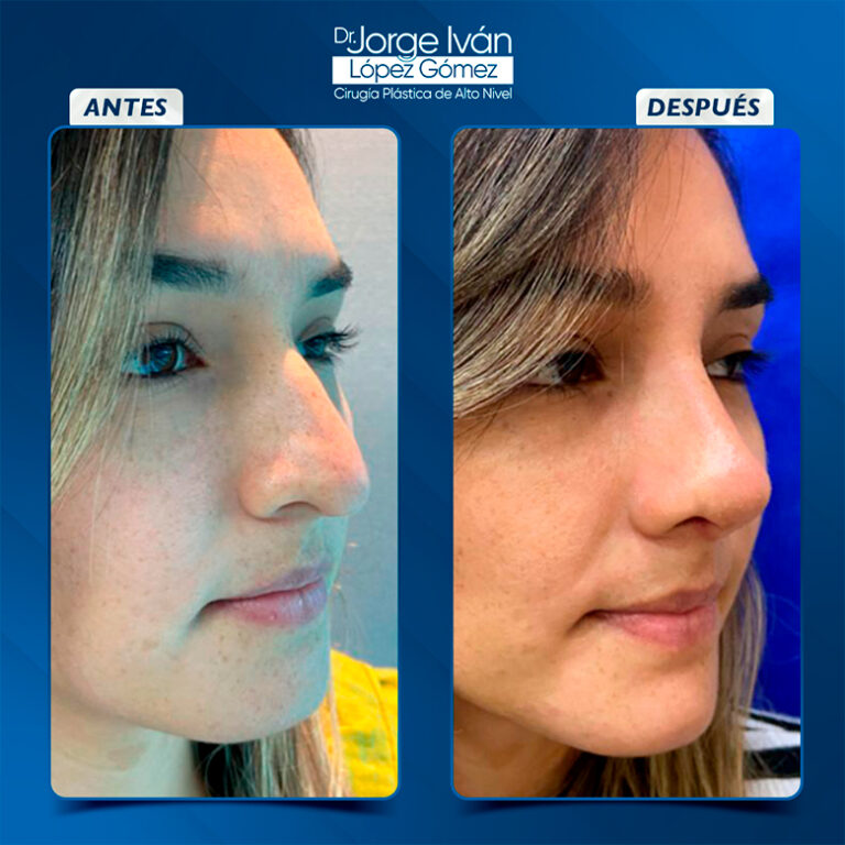 Rinoplastia-Jorgeivan3