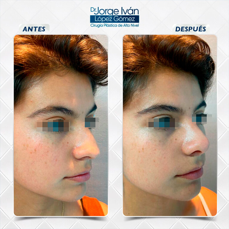 Rinoplastia-Jorgeivan4