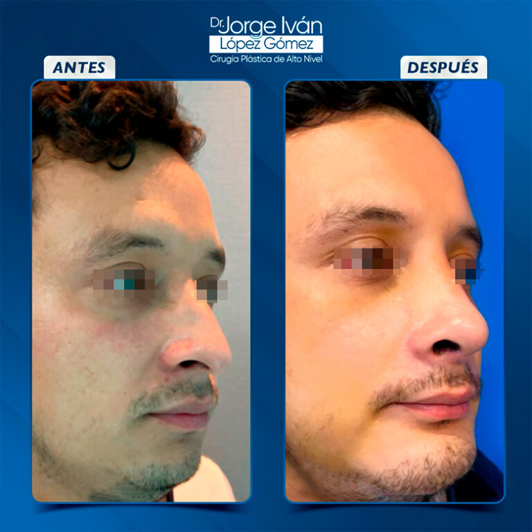Rinoplastia-Jorgeivan5