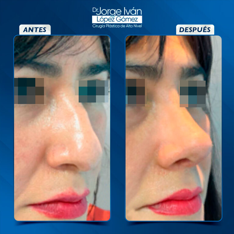 Rinoplastia-Jorgeivan6