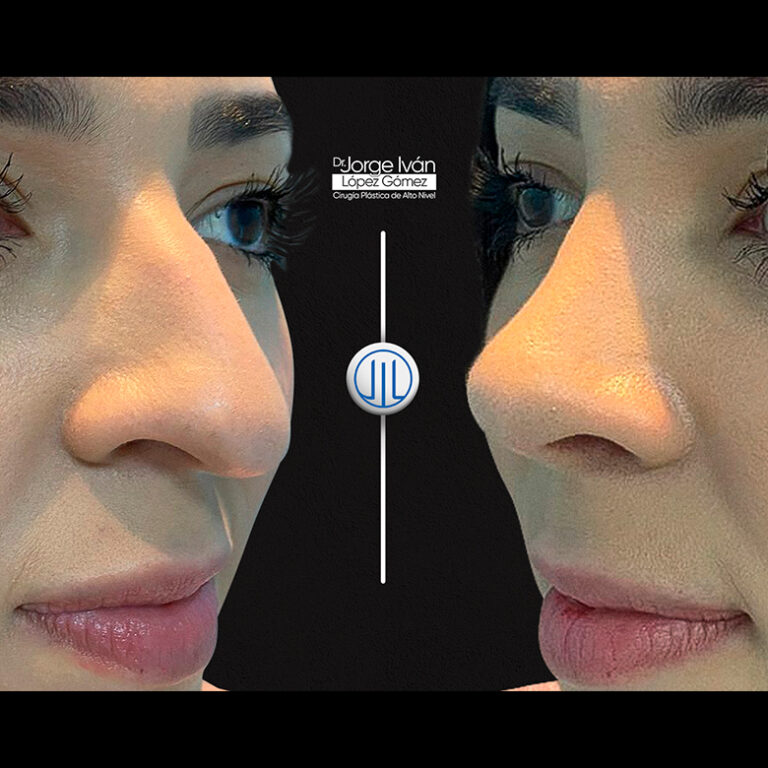 Rinoplastia-Jorgeivan7