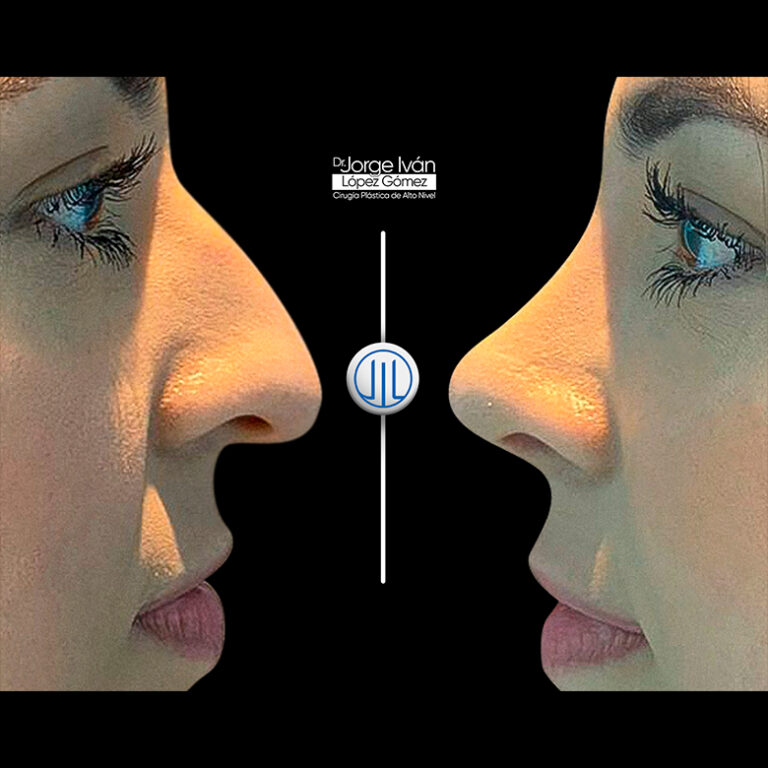 Rinoplastia-Jorgeivan8